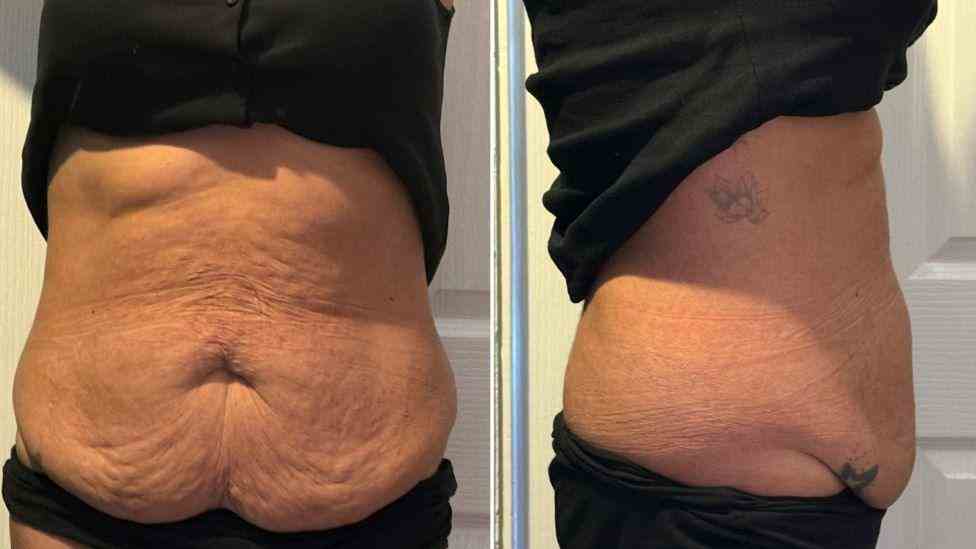 Lost the Weight but Not the Loose Skin? What You Should Know 1 Is It Definitely Loose Skin Rugby?